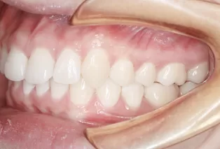 Intraoral photos after treatment