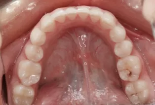 Intraoral photos after treatment