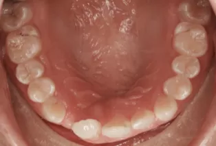 Intraoral photos after treatment