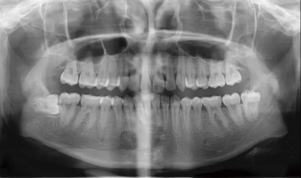 X-rays before treatment