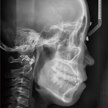 X-rays before treatment