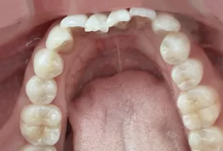 Intraoral photos