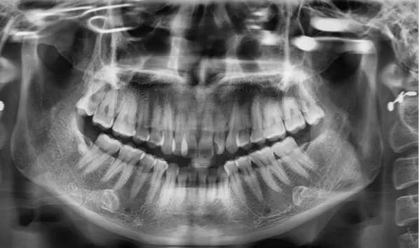 X-rays before treatment