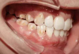 Intraoral photos