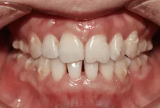 Intraoral photos