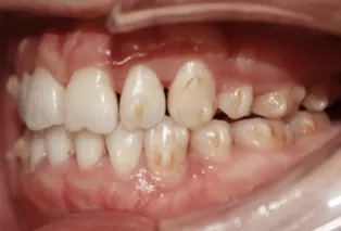 Intraoral photos