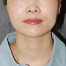 Facial photos before treatment