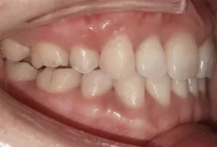 Intraoral photos after treatment