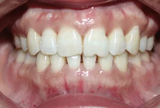 Intraoral photos after treatment