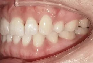 Intraoral photos after treatment