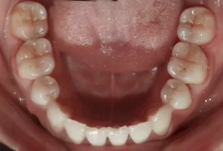 Intraoral photos after treatment