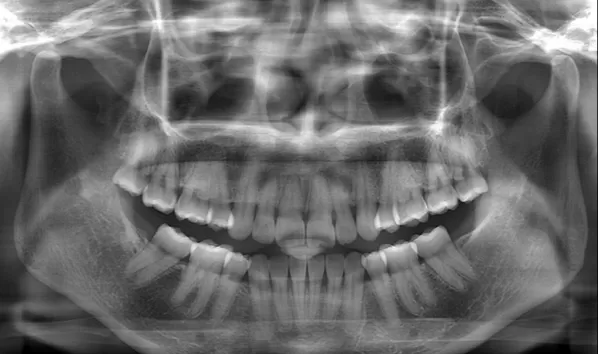 X-rays before treatment