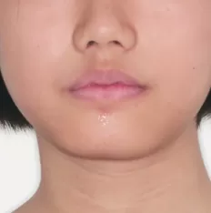 Facial photos before treatment