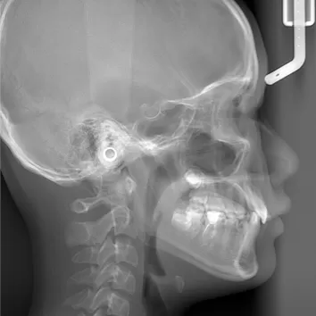 X-rays before treatment