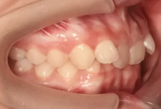 Intraoral photos