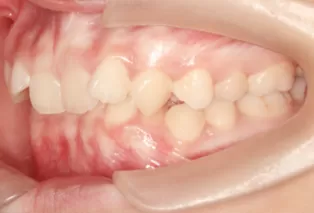 Intraoral photos