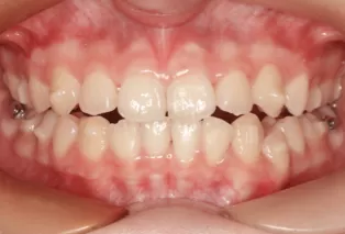 Intraoral photos