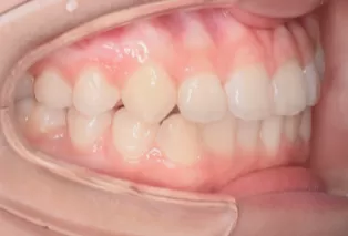 Intraoral photos after treatment