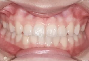 Intraoral photos after treatment