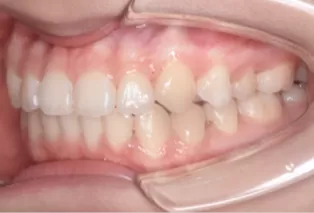 Intraoral photos after treatment