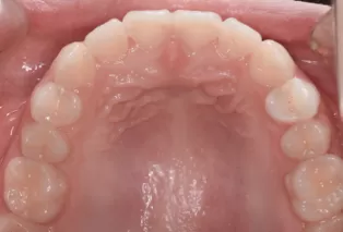 Intraoral photos after treatment