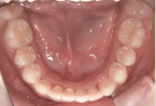 Intraoral photos after treatment