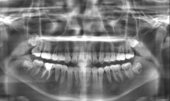 X-rays before treatment