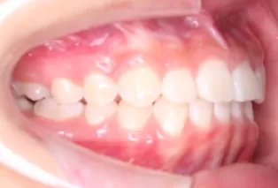 Intraoral photos after treatment