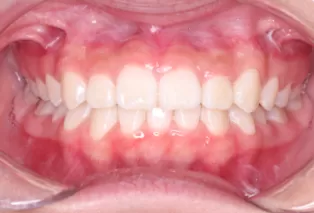 Intraoral photos after treatment