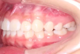 Intraoral photos after treatment