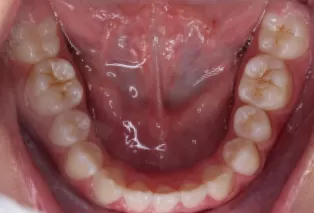 Intraoral photos after treatment