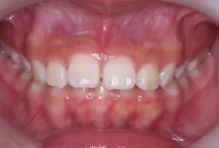 Intraoral photos