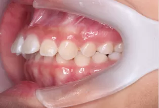 Intraoral photos