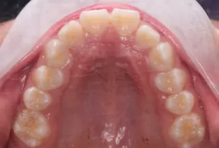 Intraoral photos