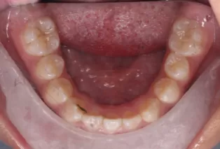 Intraoral photos