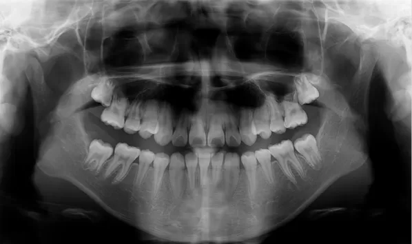 X-rays before treatment