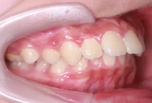 Intraoral photos