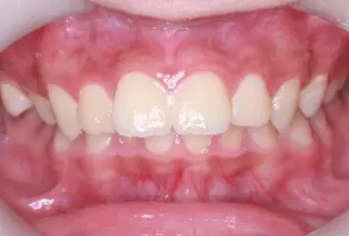 Intraoral photos