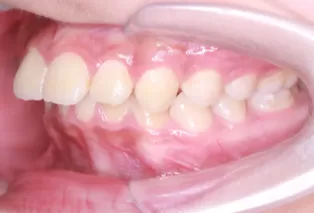 Intraoral photos