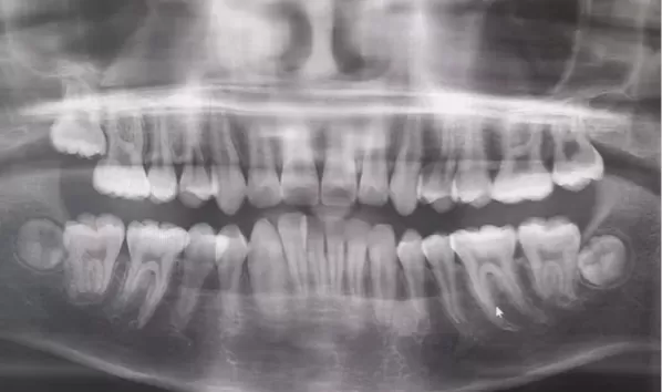 X-rays before treatment