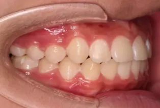 Intraoral photos after treatment