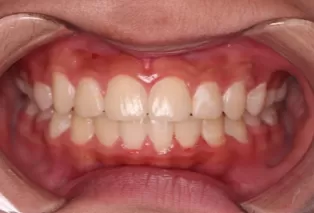 Intraoral photos after treatment