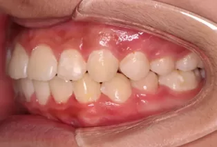 Intraoral photos after treatment