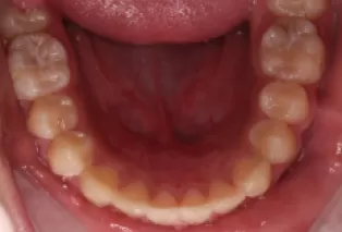 Intraoral photos after treatment