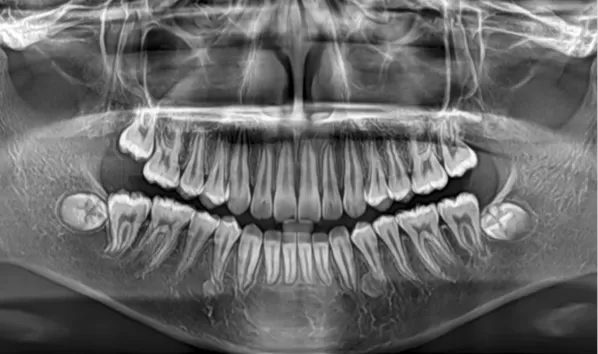 X-rays before treatment