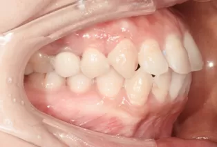 Intraoral photos