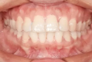 Intraoral photos