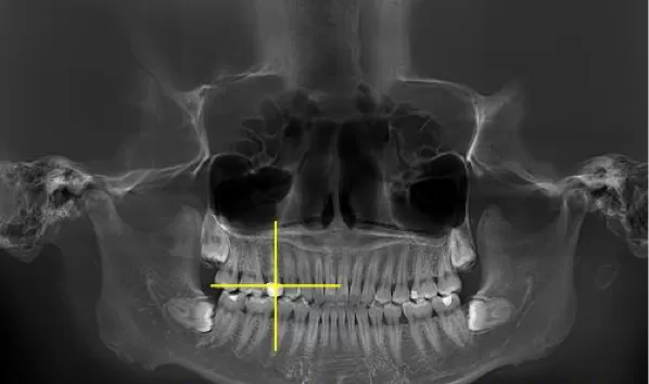 X-rays before treatment