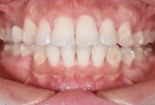 Intraoral photos