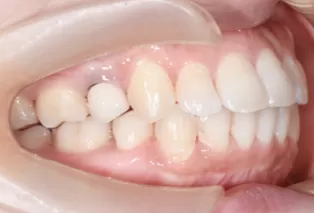 Intraoral photos after treatment